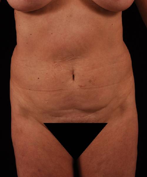 Before Tummy Tuck Female Patient Front Angle View Case 4727