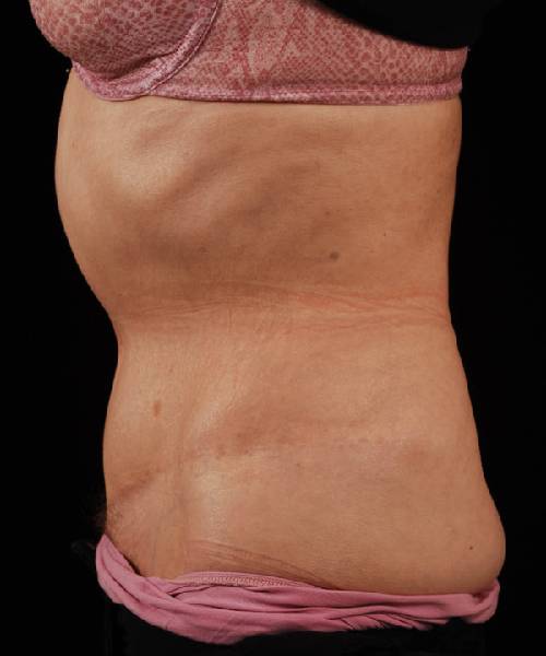 After Tummy Tuck Female Patient Side Angle View Case 4732