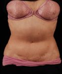After Tummy Tuck Female Patient Front Angle View Case 4732