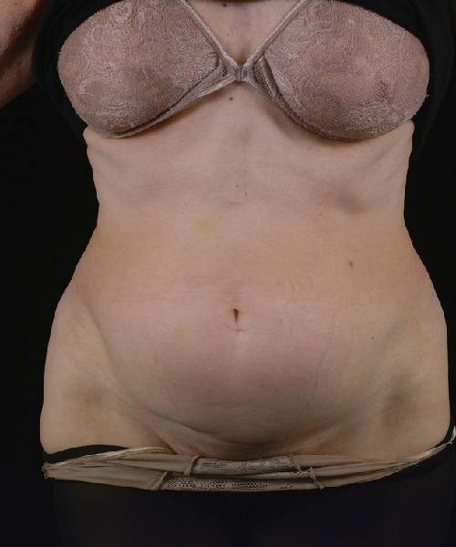 Before Tummy Tuck Female Patient Front Angle View Case 4732