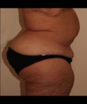 After Tummy Tuck Female Patient Side Angle View Case 4742