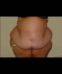 Before Tummy Tuck Female Patient Front Angle View Case 4742