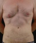 After Tummy Tuck Male Patient Front Angle View Case 4747