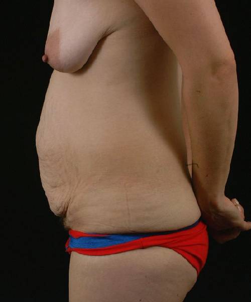 Before Tummy Tuck Female Patient Side Angle View Case 4752