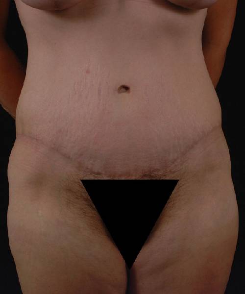 After Tummy Tuck Female Patient Front Angle View Case 4752