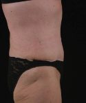after tummy tuck female patient right side view case 4757