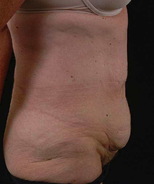 before tummy tuck female patient right side view case 4757