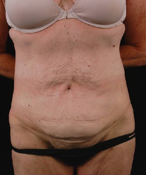 before tummy tuck female patient front view case 4757