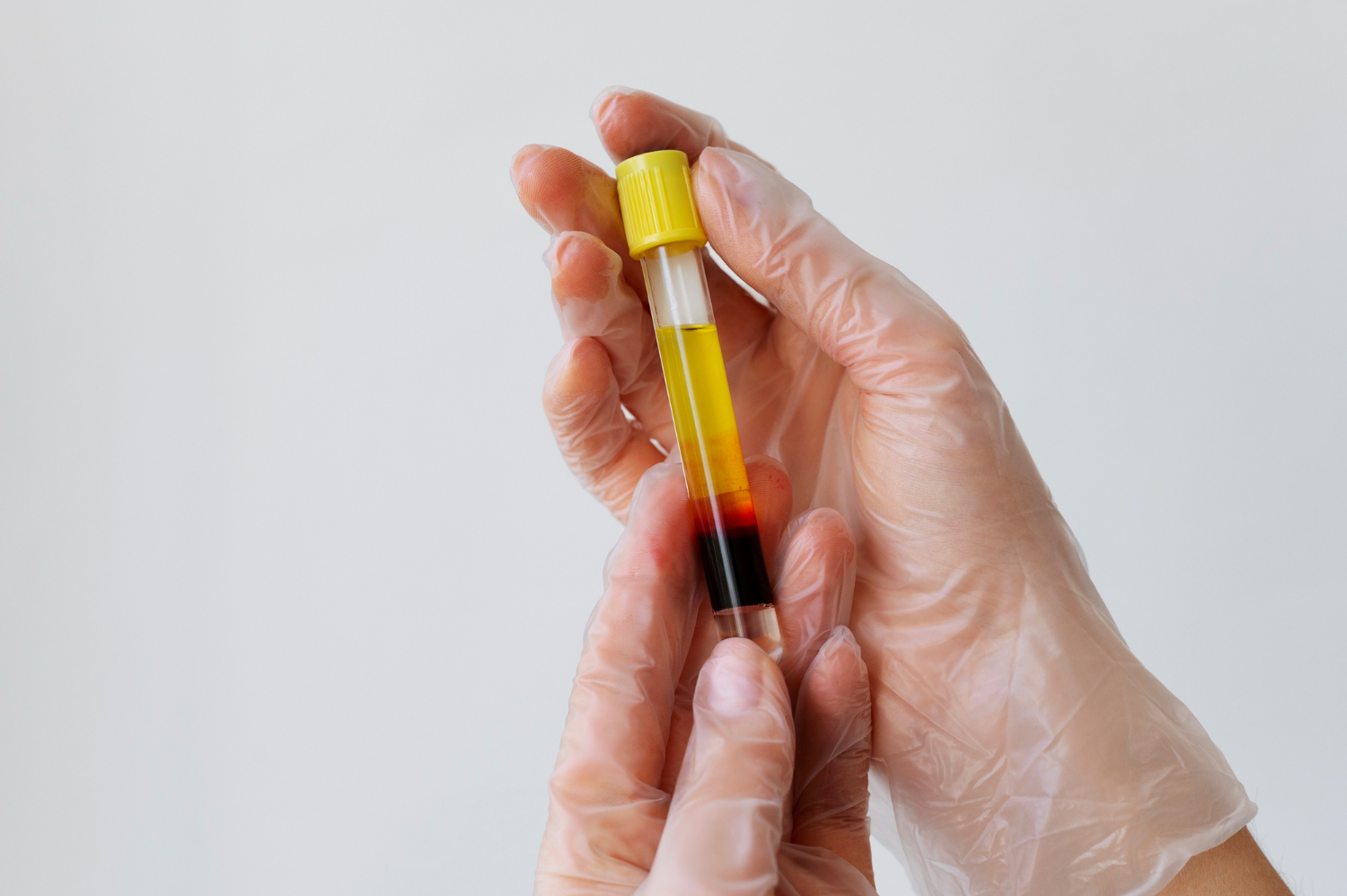 Benefits of Therapeutic Plasma Exchange