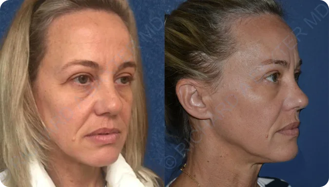 Injectable Fillers