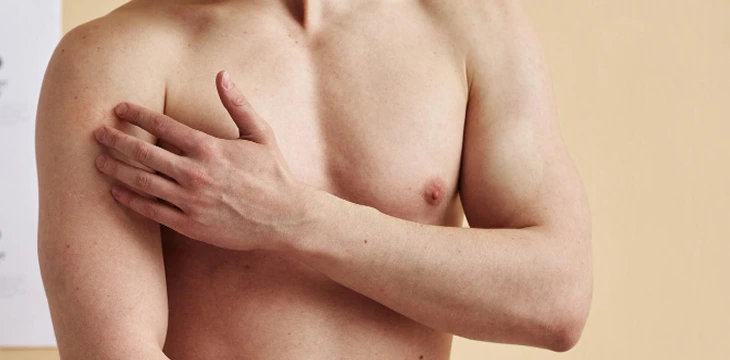 Gynecomastia 