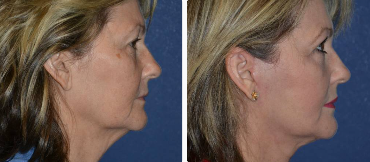 Face Lift