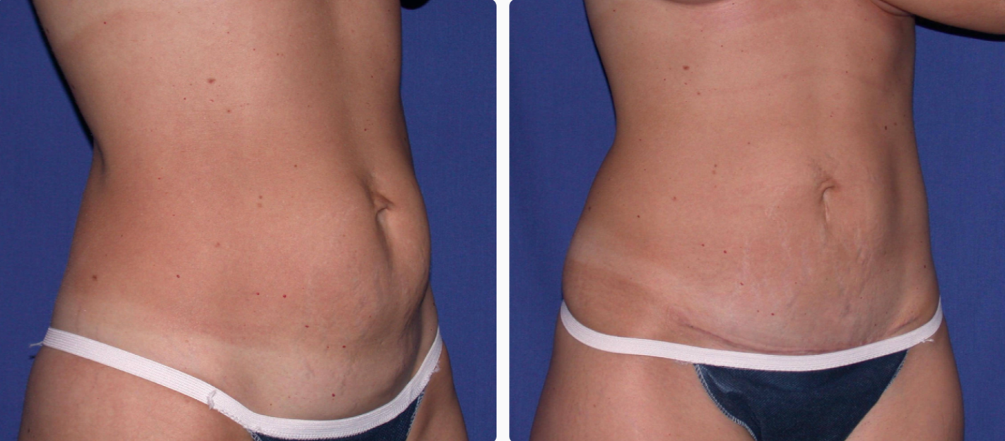Mini Tummy Tuck