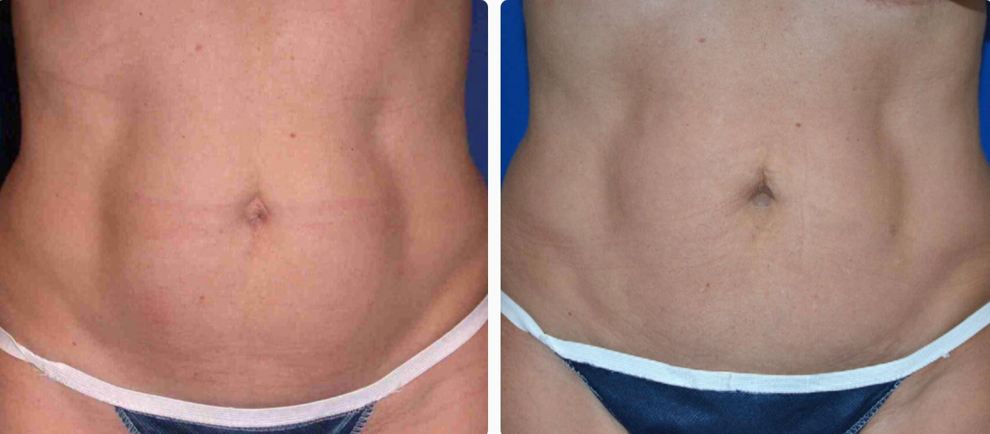 Reverse Tummy Tuck