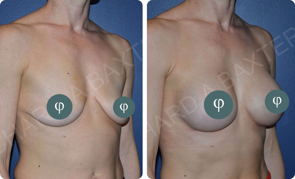 Breast Augmentation