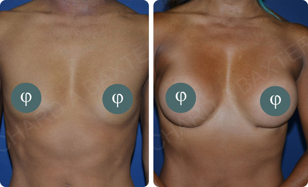 Breast Augmentation