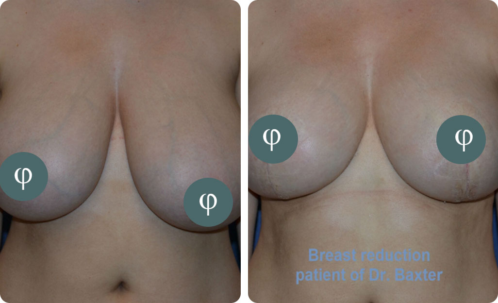 Breast Lift