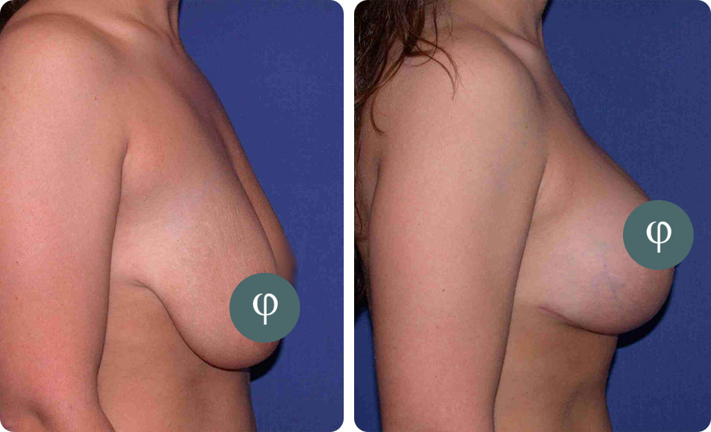 Breast Lift