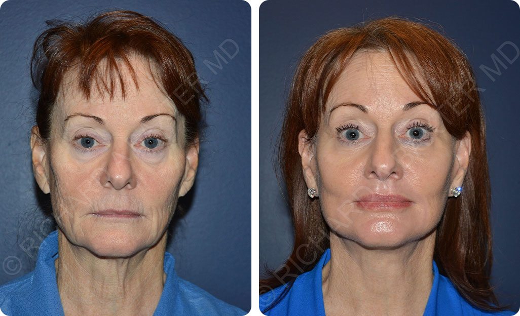 Face Lift