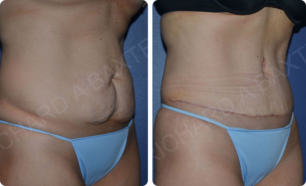 Tummy Tuck