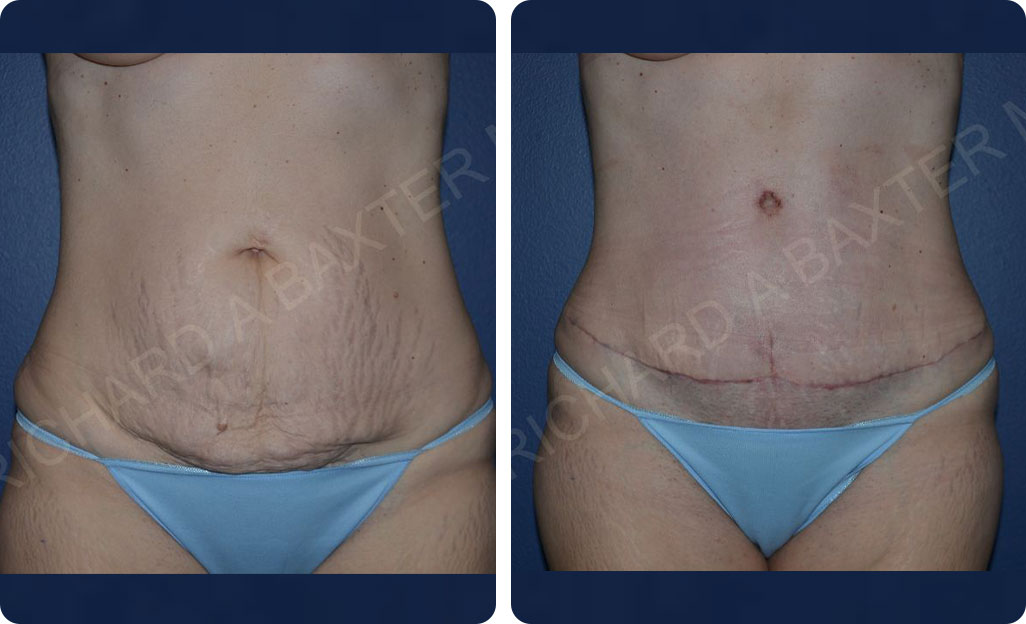 Tummy Tuck