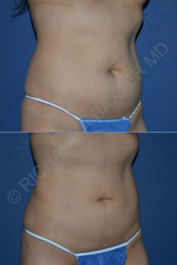 Phase-Plastic-Surgery-Blog-Body Contouring before and after female patient body contouring angle view