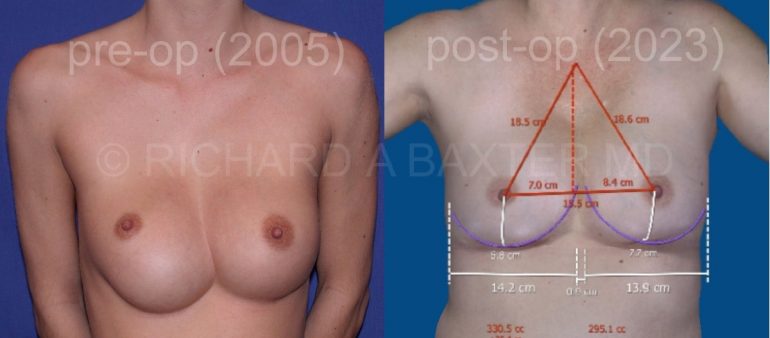 Phase-Plastic-Surgery-Blog-plastic surgery results Phase-Plastic-Surgery-Blog-plastic surgery results
