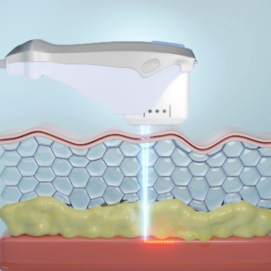 Phase-Plastic-Surgery-Blog-Ultrasound 2