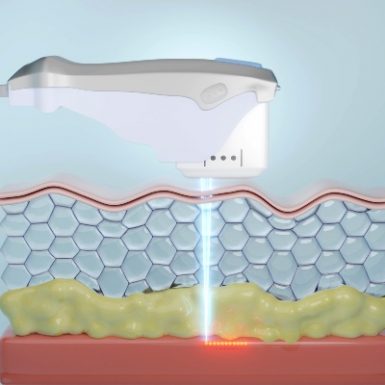 Phase-Plastic-Surgery-Blog-Ultrasound 2 Phase-Plastic-Surgery-Blog-Ultrasound 2