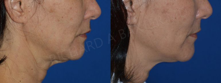 Phase-Plastic-Surgery-Blog-Ultrasound Phase-Plastic-Surgery-Blog-Ultrasound