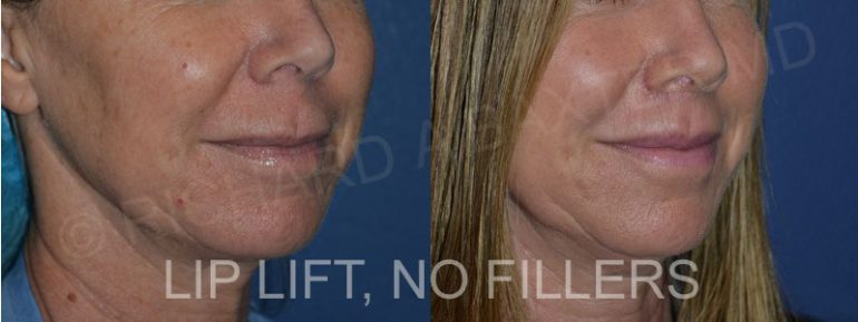 Phase-Plastic-Surgery-Blog-Injectables Phase-Plastic-Surgery-Blog-Injectables